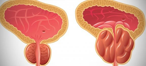 Hyperplasie de la prostate